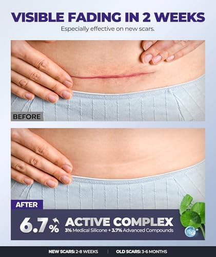 Silicone Scar Cream with 6.7% Active Ingredients, Scar Gel Visible in 2 Weeks, Moisturizing Scar Removal Clinically Show for Surgical, C-Section, Keloid, Acne & Burn Scars, Stretch Mark Cream(55ML) view 2