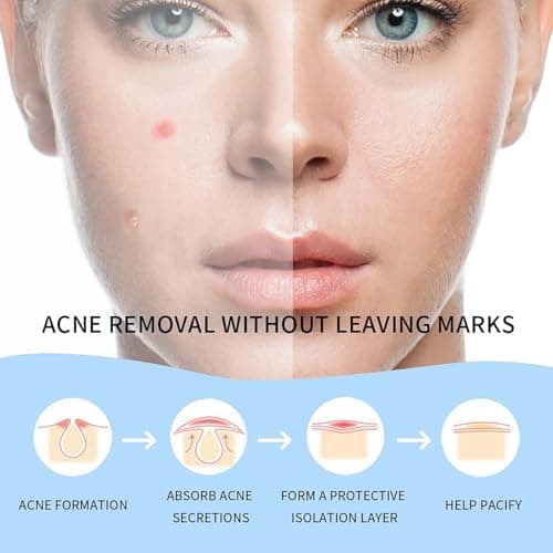 Safirst Zit Patch Hydrocolloid Pimple Patches Acne Patches 2 Sizes Invisible Spot Blemish Stickers Easy Removal Treatment for Breakouts Absorbs Zits Hiding Face Emergency Treatments view 3