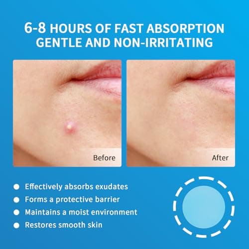 Pimple Patches for Face Hydrocolloid Acne Patches, Invisible Zit Stickers Covering Blemishes, 3 Size Hydrocolloid Spot Stickers for Face and Skin (144 Count(Pack of 1)) view 2