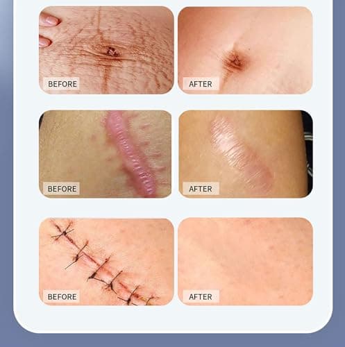 Silicone Scar Sheets Scars Removal Treatment 3PCS Medical Grade Scar Tape for Surgical Scars Resuable Strip for Tummy Tuck,Incision,Keloid,C-Section,Burn,Acne Scars view 6