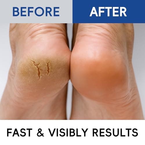 2 Pack Urea Cream 40% + 2% Salicylic Acid, 3.53 oz - Maximum Strength Foot & Hands Moisturizer for Rough, Dry Cracked Skin, Callus Remover with Deep Hydration, Intensive Repair for Feet, Heels view 5