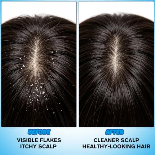 1% Ketoconazole Anti-Dandruff Shampoo for Flaking & Itchy Scalp, 7.78Fl Oz | Deep Cleansing Care, Targets the Root Cause of Dandruff, Suitable for Men & Women view 6