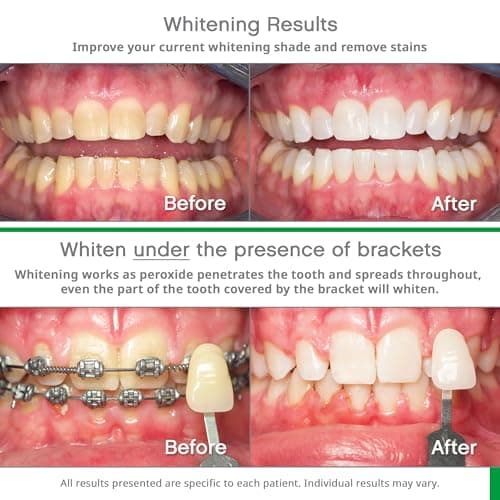 Opalescence Go 15- Prefilled Teeth Whitening Trays Kit - 15% Hydrogen Peroxide - (10 Treatments) Dentist Recomended - Made by Ultradent Products. Teeth Whitening Kit -Mint - 5194-1 view 5